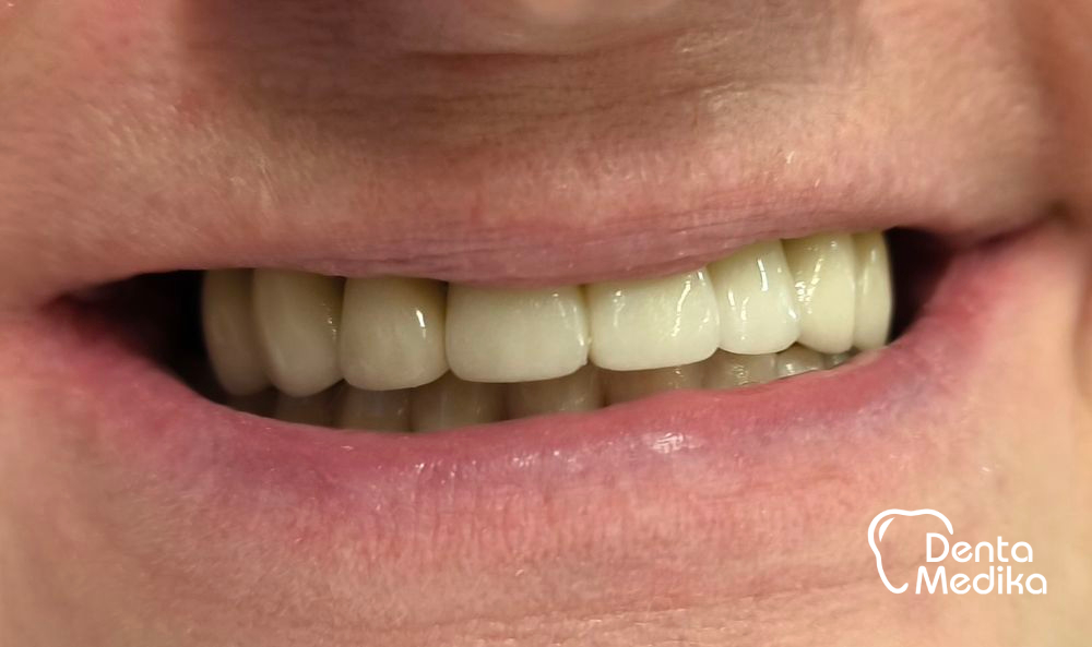 Třmenová hybridní náhrada na implantátech pro bezzubou čelist 9